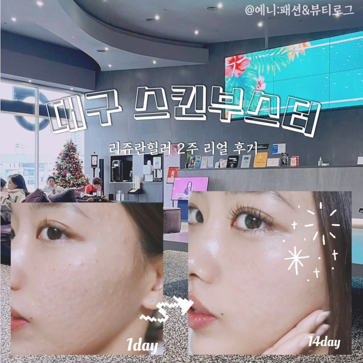  대구스킨부스터 대구성형외과 리쥬란 2주 후기