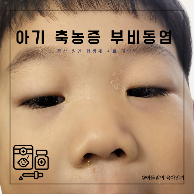 아기 축농증 부비동염 증상 원인 항생제 치료 예방법