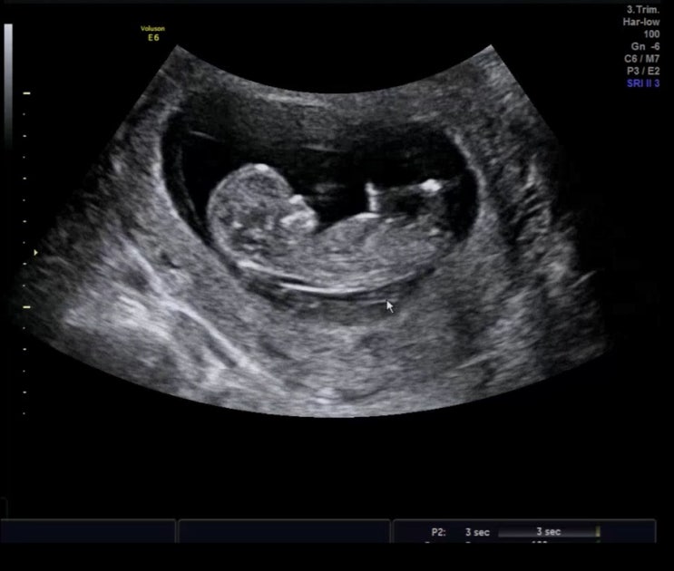 [디나제제의 임신 일기] 임신초기 10주차~12주차기록, 첫 피비침/갈색냉/1차기형아검사/복부초음파