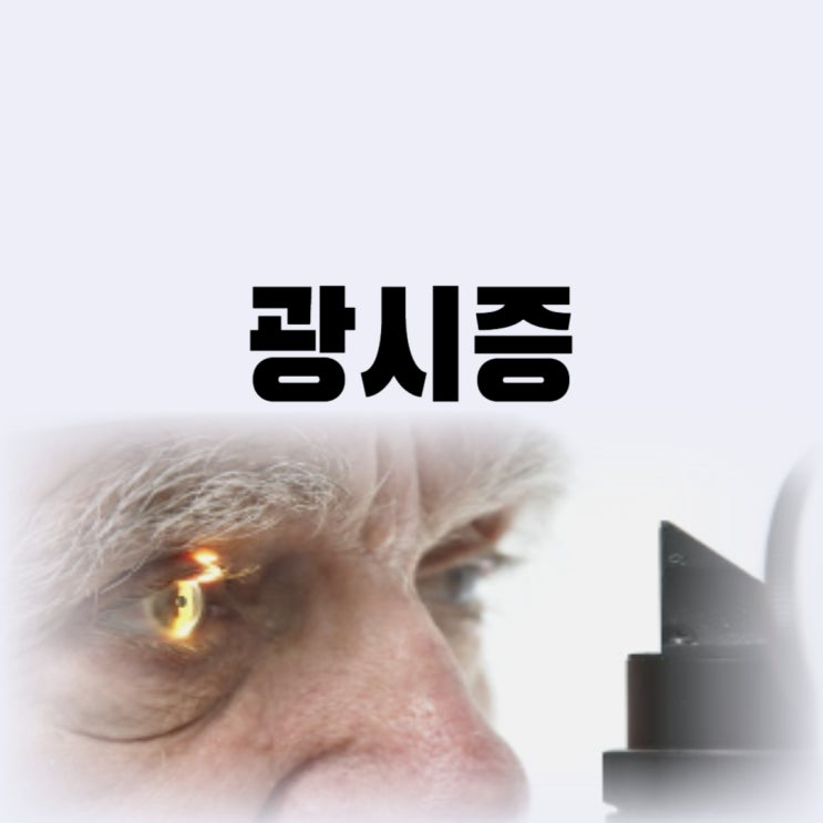  광시증 증상 원인 방치하면 실명 위험성