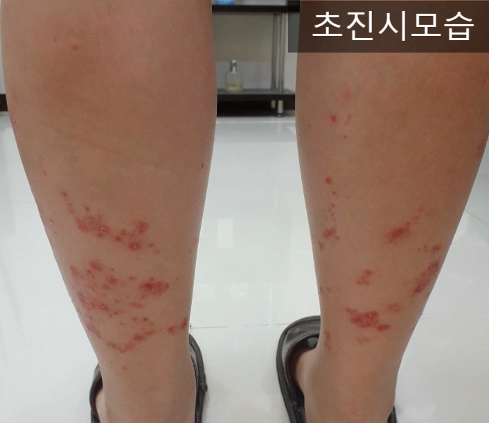  겨울철에 더 심해지는 건선, 올바른 치료법과 관리 방법 알아봅시다.
