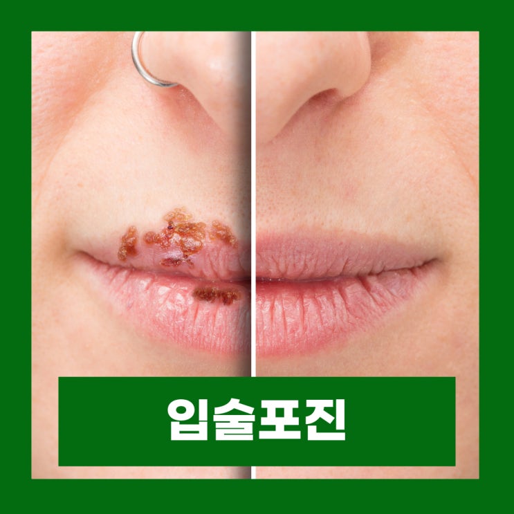  입술포진 증상 입술 헤르페스 원인 전염 구순포진 연고 약