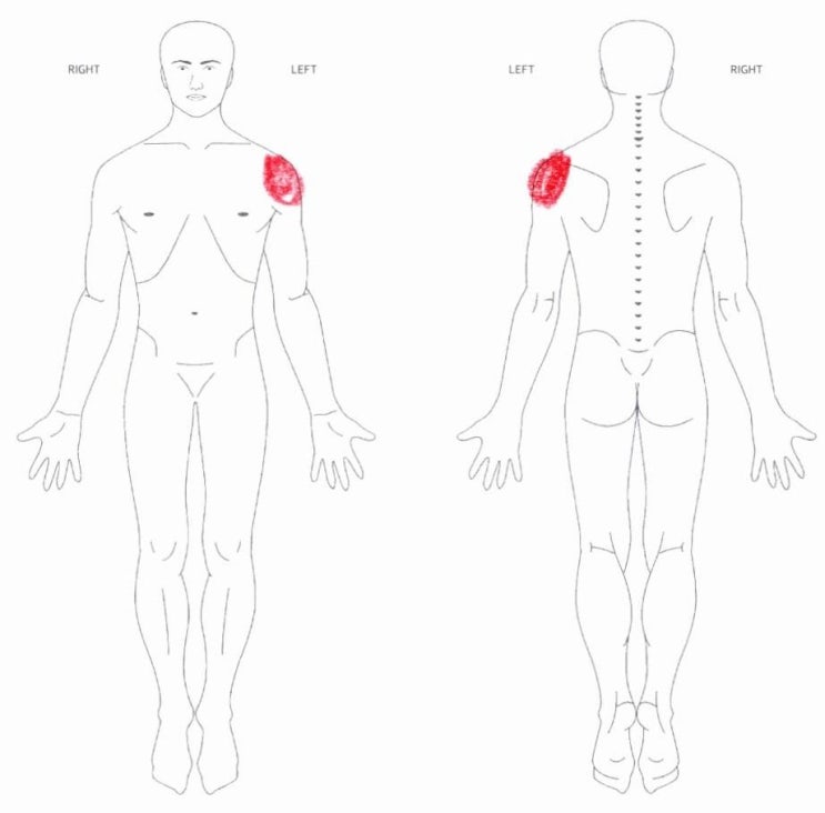  광주정형외과, 어깨 통증 견봉 성형술 후 재활 치료