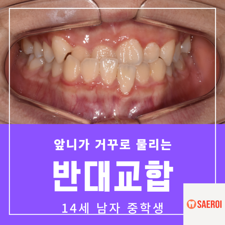  앞니가 거꾸로 물리는 반대교합 / 14세 중학생 남자