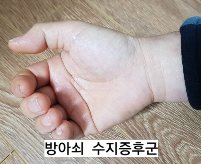 방아쇠 손가락증후군(방아쇠 수지증후군)의 진단과 치료 방법ㅡ정형외과 엑스레이와 초음파....