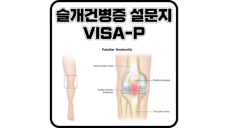  슬개건병증(Patella tendinopathy)설문지(VISA-P)
