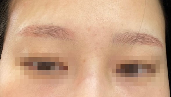  피코레이저 눈썹문신제거 2회차 후기, 눈썹문신이 지워지는 3가지 과정 및 주의사항