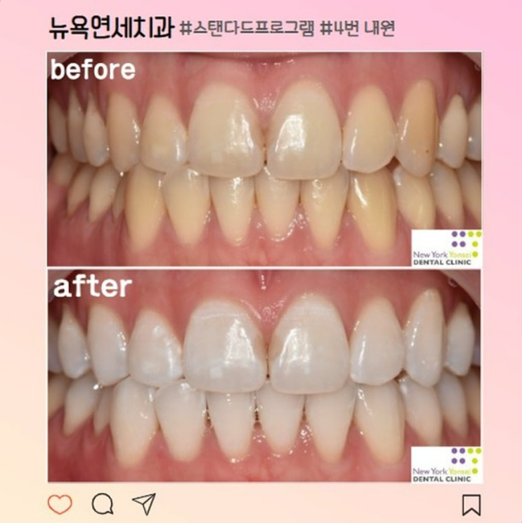 강남역 치과 치아미백 가격/효과 솔직후기