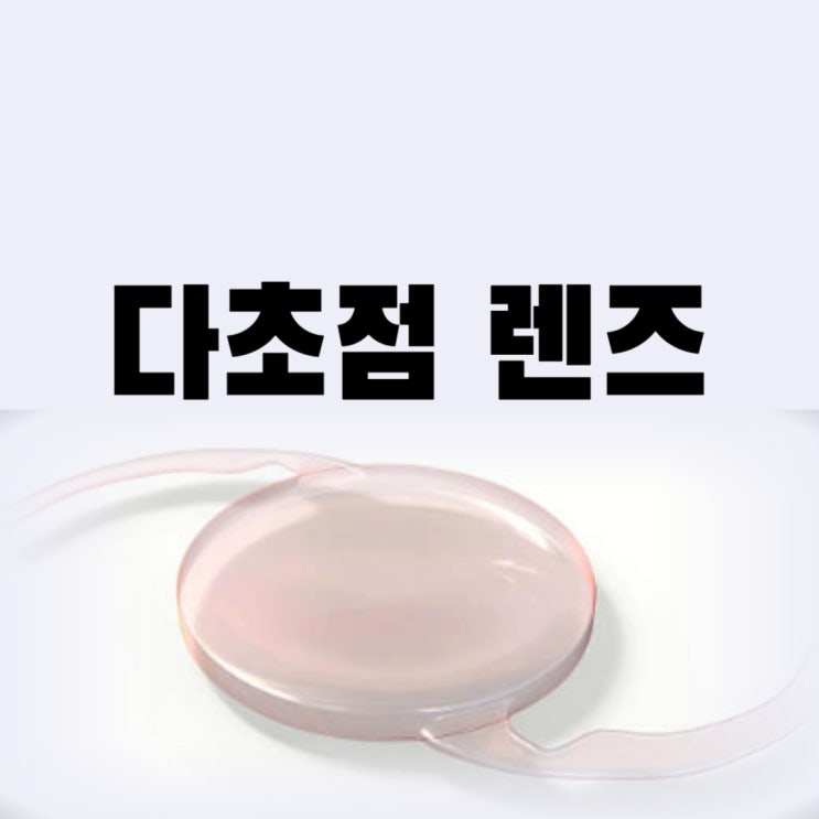  백내장 렌즈 삽입 다초점렌즈 단점 종류 부작용 괜찮을까