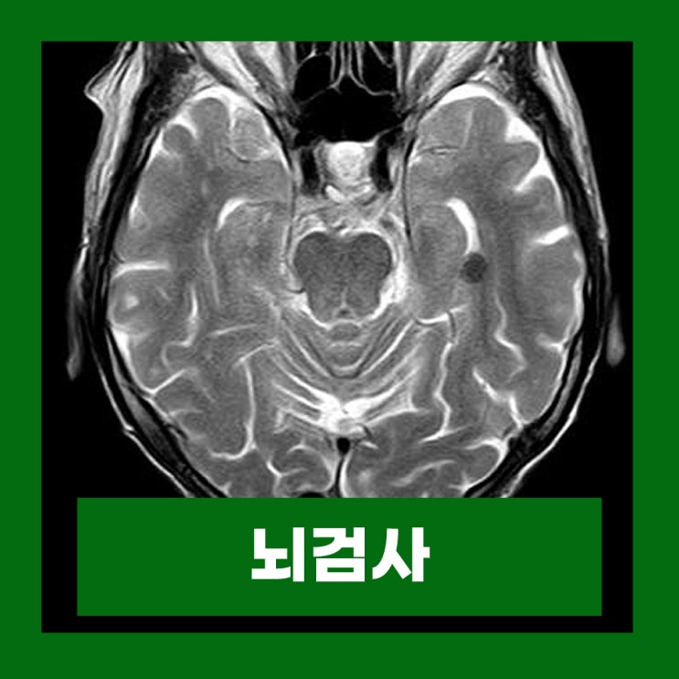  뇌 머리 MRI MRA CT 검사 차이 뇌혈관 조영술 검사시간