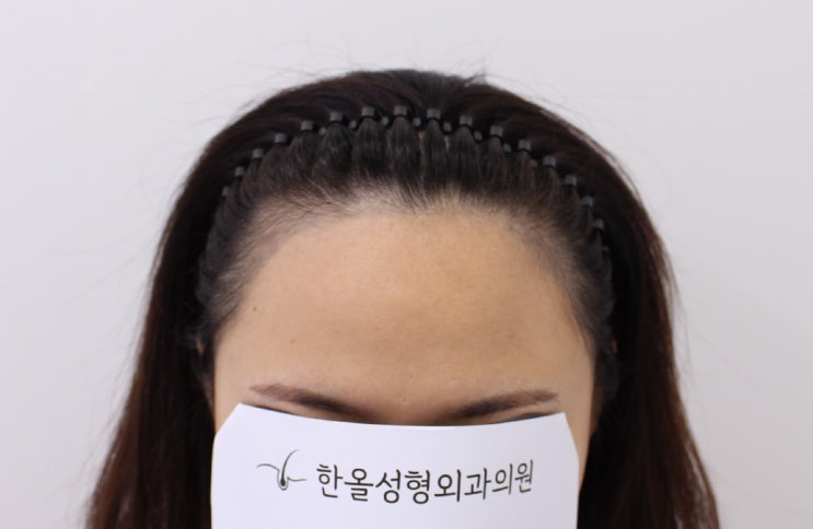  30대 여자 비절개 헤어라인 수술 1일차