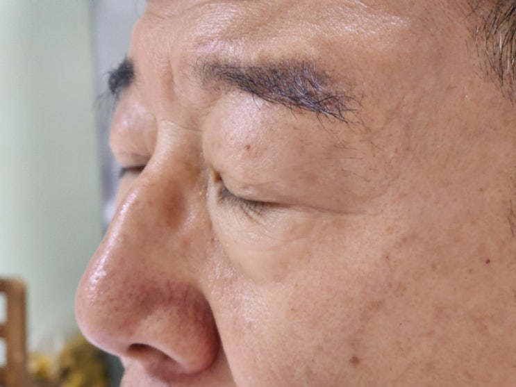 강남역성형외과 에서 중년눈수술 눈썹하거상술 6개월 후기