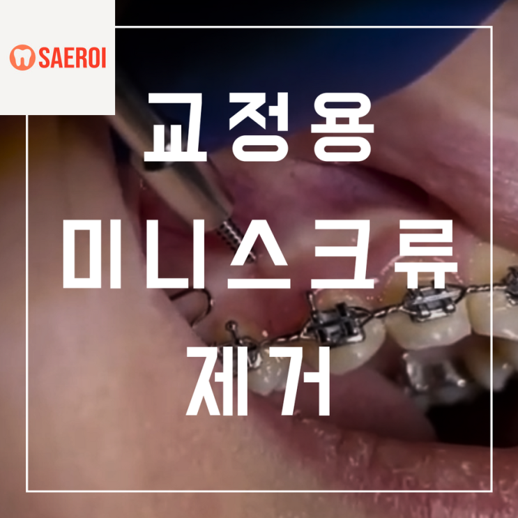  교정용 미니스크류 흔들거림 / 제거는 어떻게 하나요?