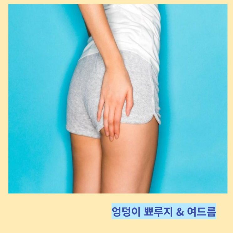 엉덩이 뾰루지 여드름 원인 및 케어법 엉덩이 뾰루지 여드름 원인 및 케어법