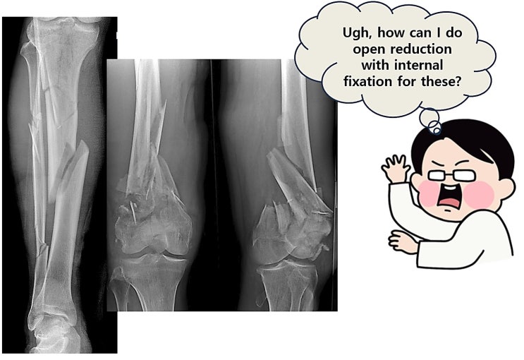 3-14 수술 중 단계, Severe comminuted closed fracture는 무턱대고 ORIF부터 하지 마라!