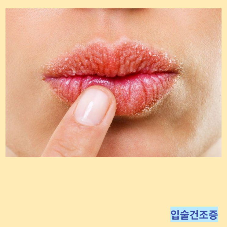바삭바삭 마르는 입술건조증 입술갈라짐 입술껍질 완화 방법