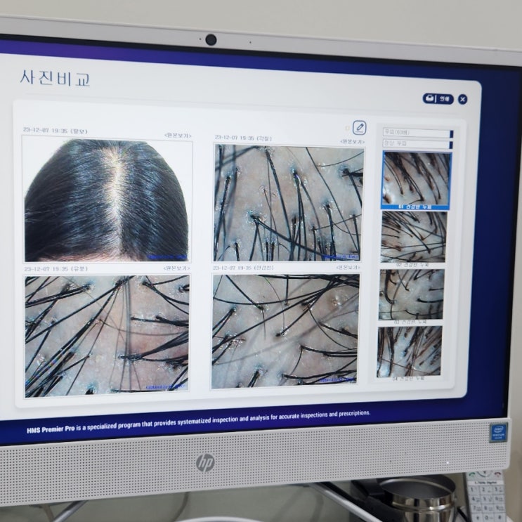  인천 구월동 탈모 두피관리 모바이오 두피관리샵 인천 탈모 걱정된다면