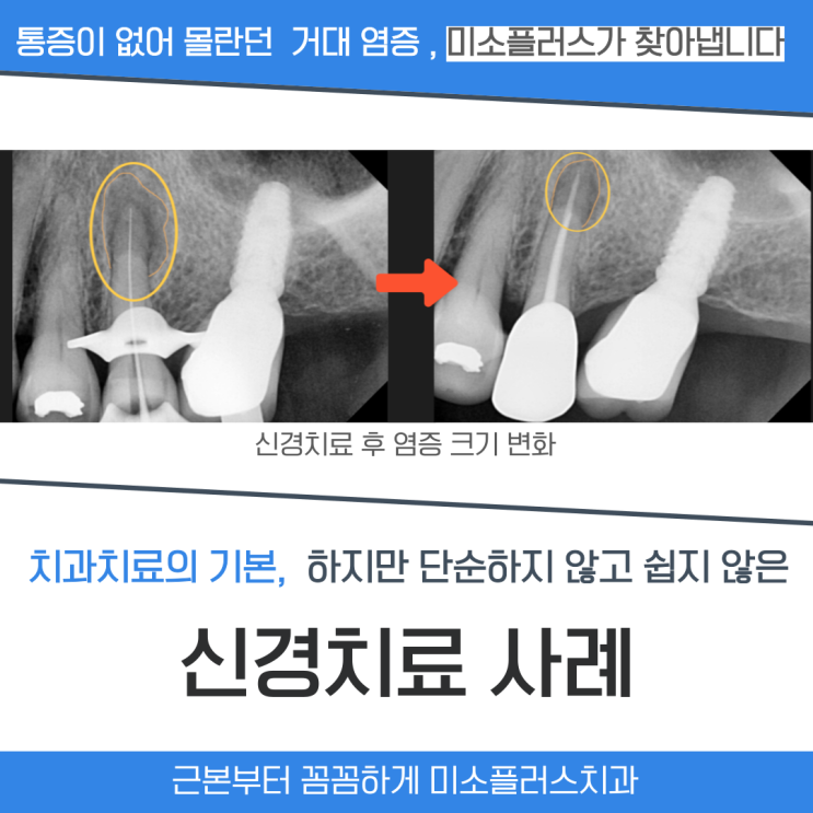  통증없는 거대염증으로부터 신경치료를 통한 자연치 살리기