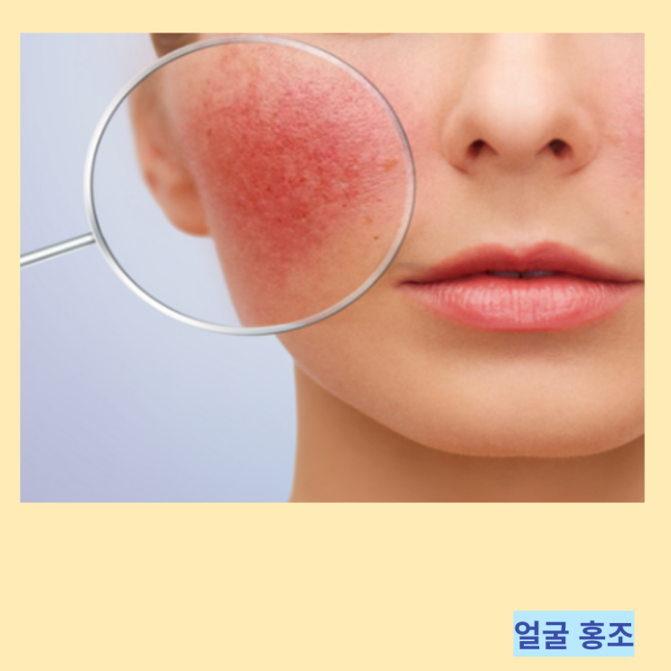 안면홍조 없애는법 얼굴 홍조 원인 및 해결 방안 안면홍조 없애는법 얼굴 홍조 원인 및 해결 방안