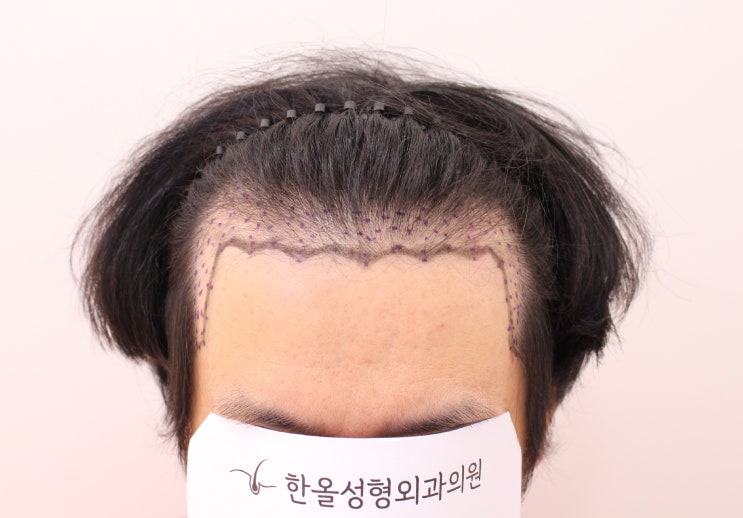  40대 남자 비절개 마이크로컷 헤어라인 3000모 2주 경과