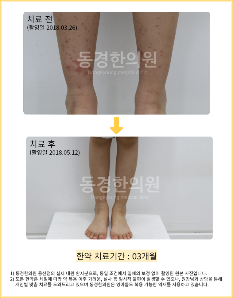 알레르기 자반증 증상 자가진단법과 치료 방법