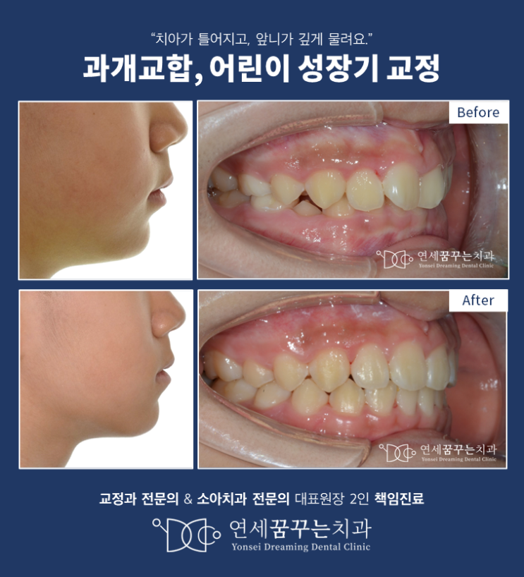 하남미사 교정 전문, 어린이 성장기 교정이 필요한 이유!