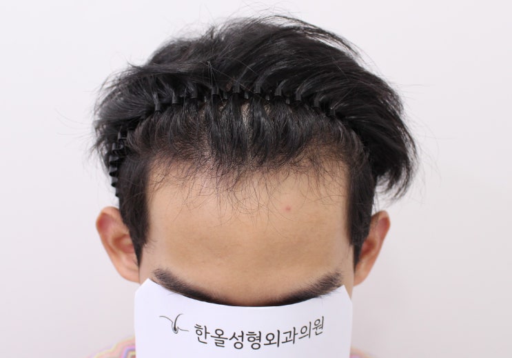  20대 남자 헤어라인 비절개 2500모 수술 당일