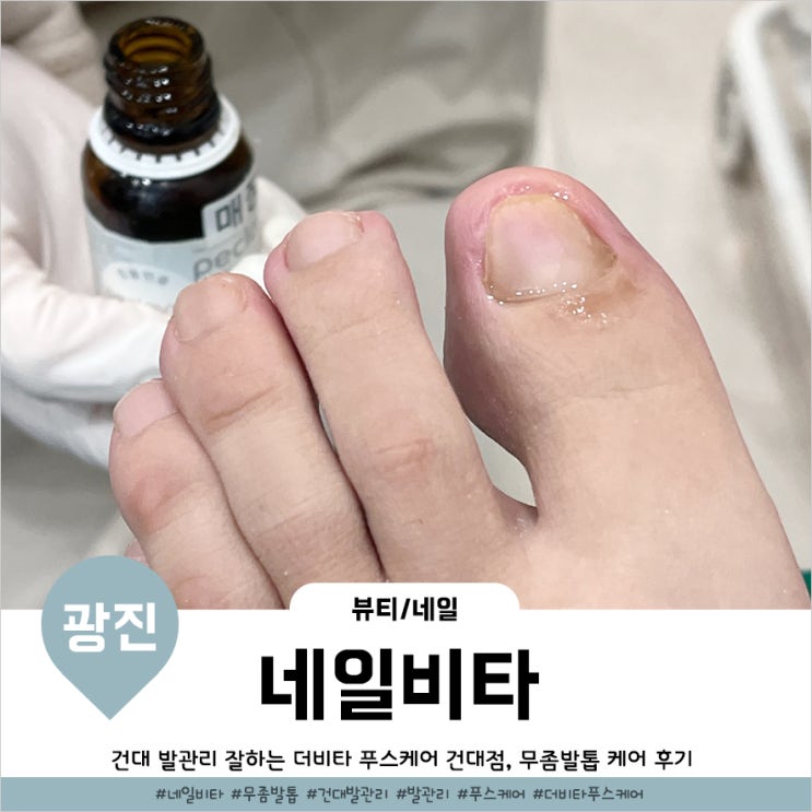  건대무좀발톱 케어잘하는 네일비타 푸스케어 건대점 후기