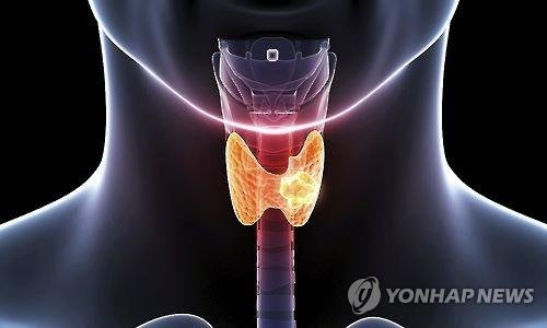 갑상선 기능 장애, 노쇠 위험 증가시켜 갑상선 기능 장애, 노쇠 위험 증가시켜