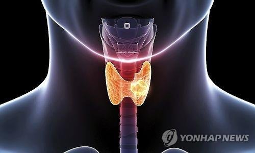 갑상선 기능 장애, 노쇠 위험 증가시켜