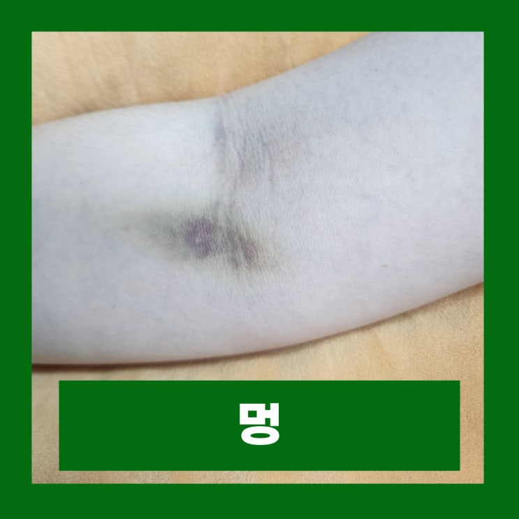  멍 빨리 빼는법 피멍 빠지는 시간 약국 멍크림 종류