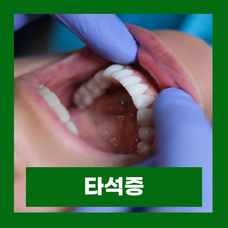  침샘 타석증 혀밑 침샘결석 원인 증상 치료