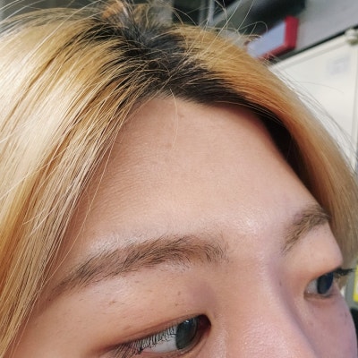 대구이마필러 이마 미간 보톡스 한달차후기 붓기 : 네이버 블로그 대구이마필러 이마 미간 보톡스 한달차후기 붓기 : 네이버 블로그