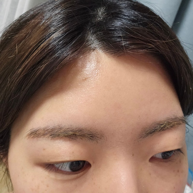 대구이마필러 이마 미간 보톡스 한달차후기 붓기 : 네이버 블로그 대구이마필러 이마 미간 보톡스 한달차후기 붓기 : 네이버 블로그