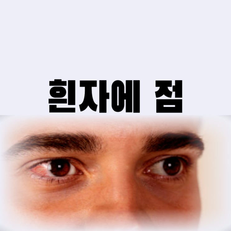  흰자에 점 결막 모반제거 비용 부작용까지