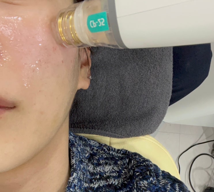  연신내 피부과 엑소좀 포텐자 펌핑팁 2차 시술받은 이유 리얼후기