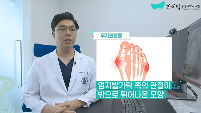  [온천동PT] 엄지발가락 휘어짐 무지외반증 허리통증 무릎통증 무지외반증 치료