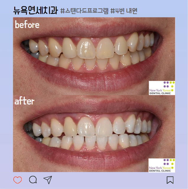 [강남역 치과] 치아미백 효과와 통증 및 횟수