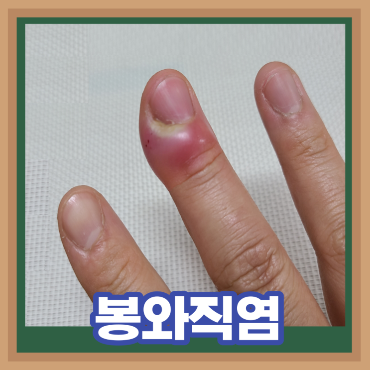 손가락 발가락 봉와직염 증상 재발 치료 수술 (연조직염)