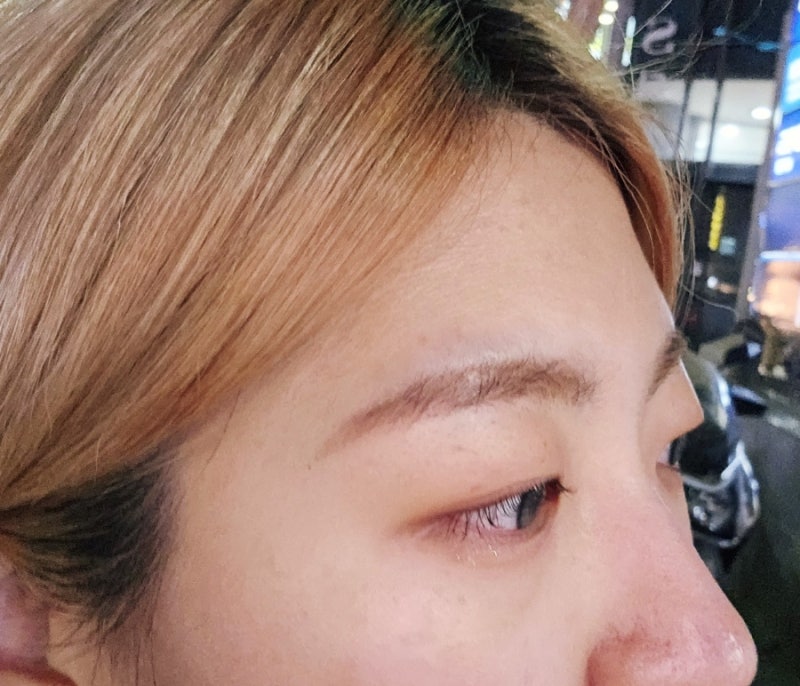 대구이마필러 이마 미간 보톡스 한달차후기 붓기 : 네이버 블로그 대구이마필러 이마 미간 보톡스 한달차후기 붓기 : 네이버 블로그