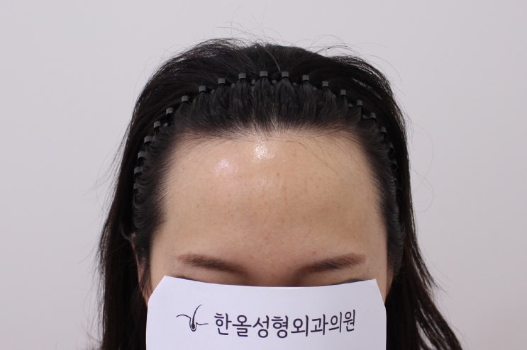  30대 여자 헤어라인 비절개 마이크로컷 3000모 수술 2일차