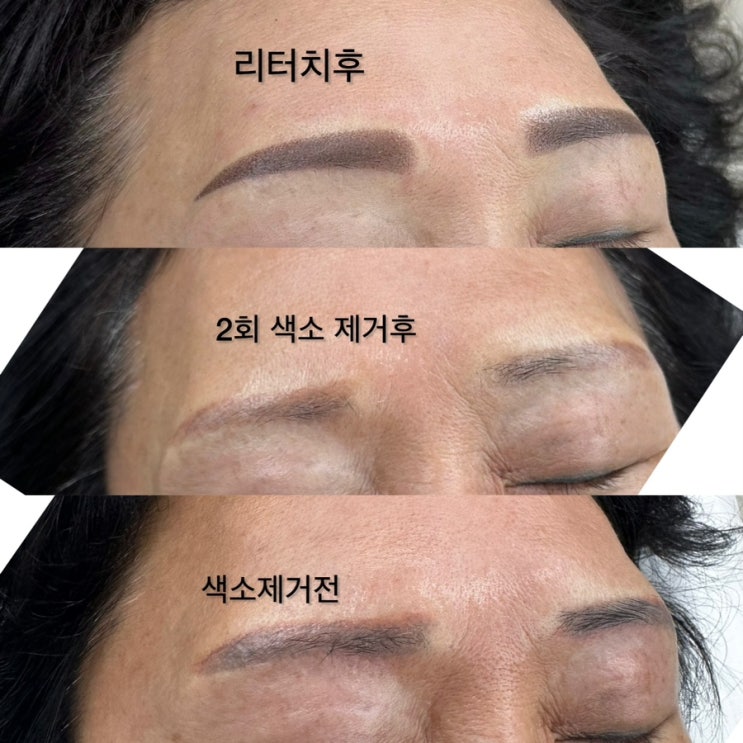  눈썹문신제거 고민은 예쁨을 늦출뿐