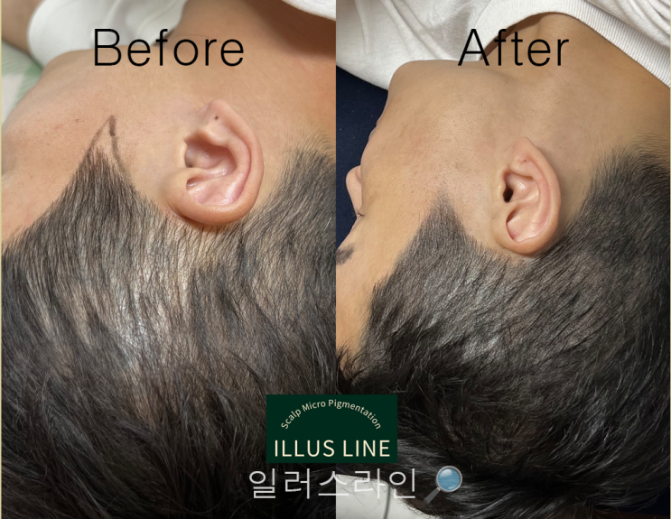  smp 두피문신가격, 합리적인 비용으로 두피문신 받고싶다면,부천 두피문신 일러스라인-
