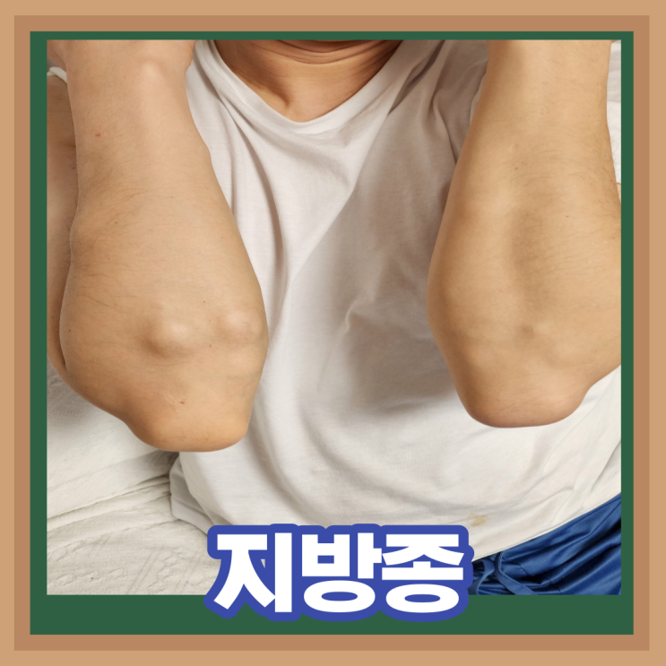  이마 얼굴 목뒤 등 피부 지방종 원인 통증 제거 수술