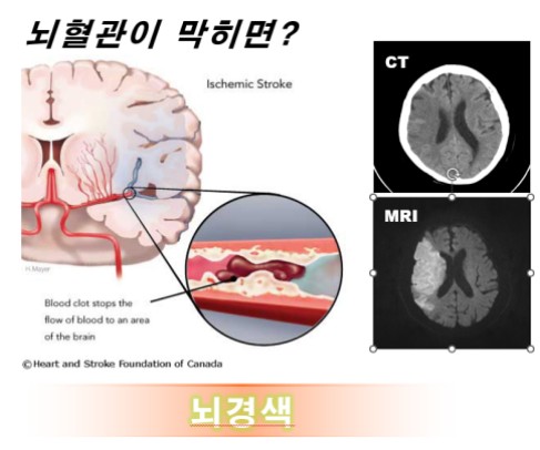  지병에 의한 졸중풍이 재해에 해당하는지 여부