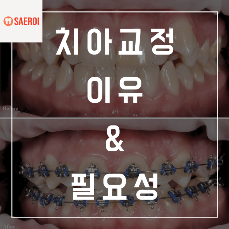 치아교정을 왜 하고 싶으신가요? 하고 싶은 이유와 필요성?