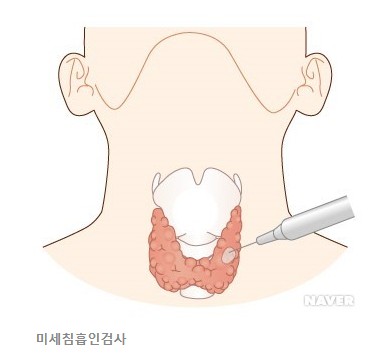  약관상 진단방법으로 명시되지 않은 미세침흡인검사에 의한 암진단 인정여부