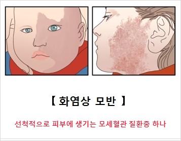  화염상 모반치료를 위한 레이저수술의 수술인정 여부