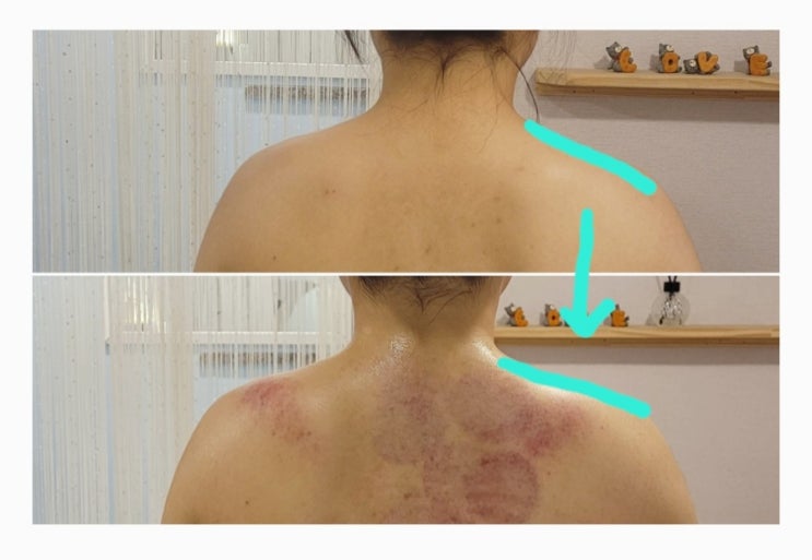  발산역 웨딩케어 피부를디자인하다 상체관리 후기