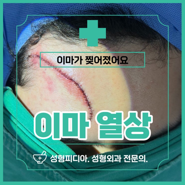  [이마열상] 이마 봉합부터 실밥제거까지 자세히 알아봅시다. (feat. 성형외과 전문의)